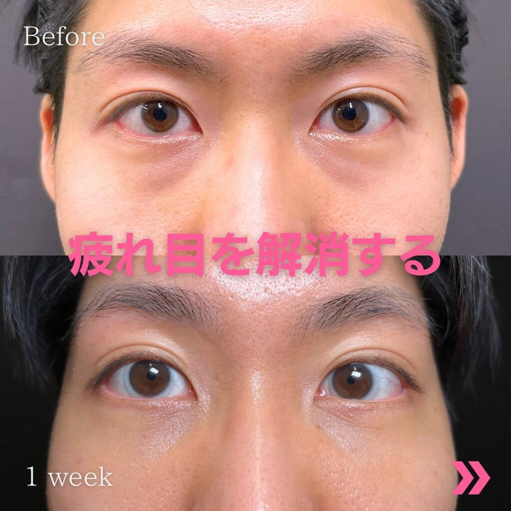 疲れ目を解消した症例写真