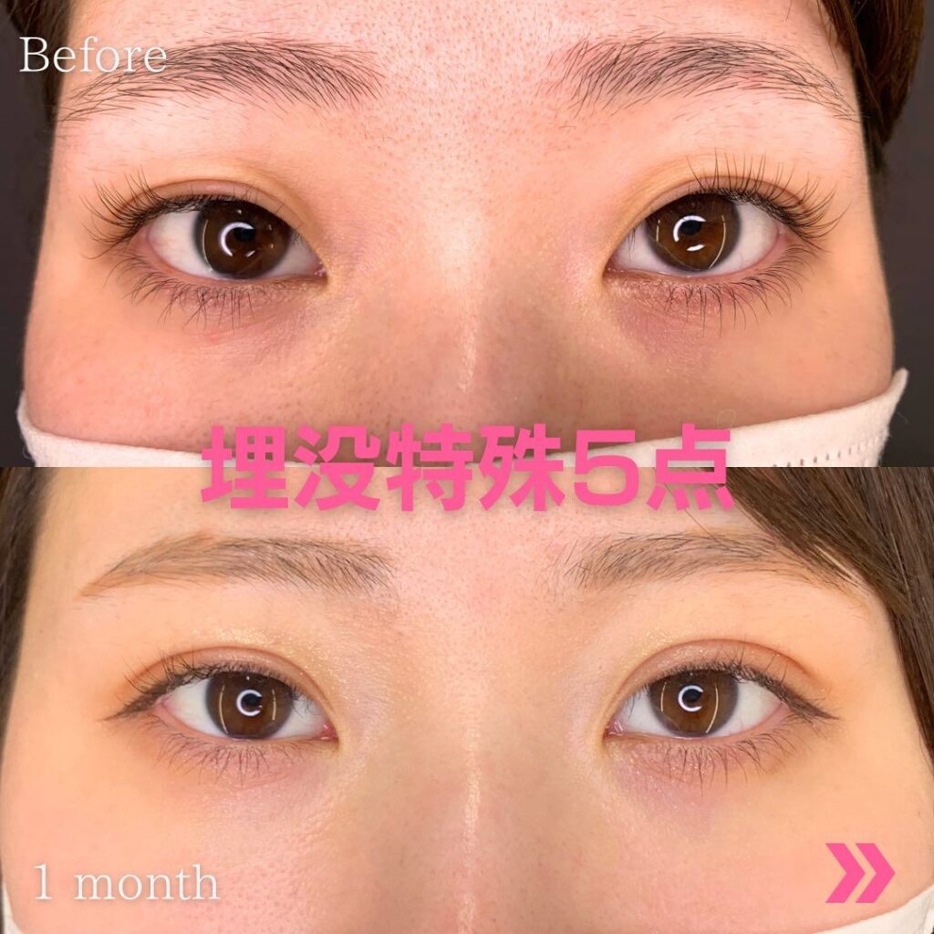 埋没特殊５点の症例写真