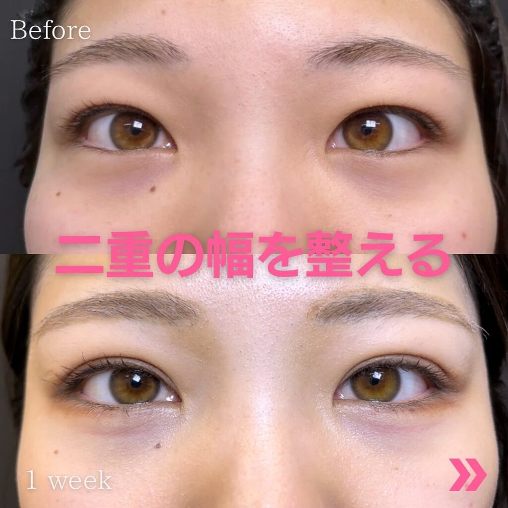 二重整形の症例写真