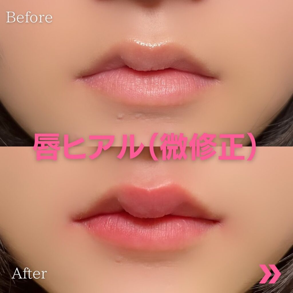 唇ヒアルロン酸の症例写真