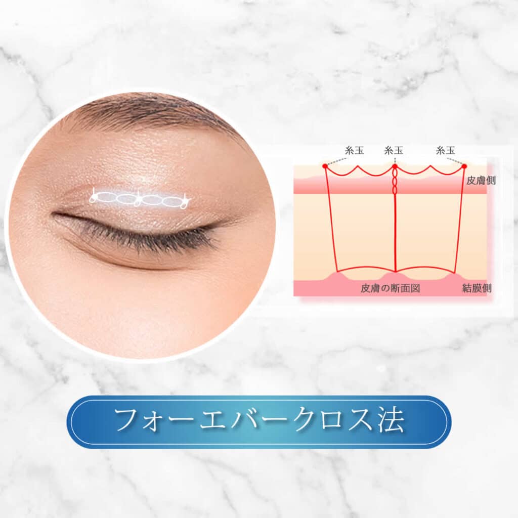 フォーエバークロス