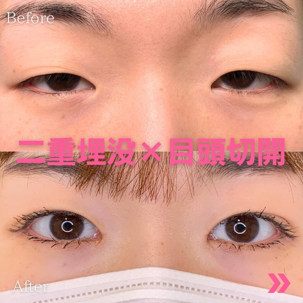 埋没法と目頭切開を同時にした症例写真