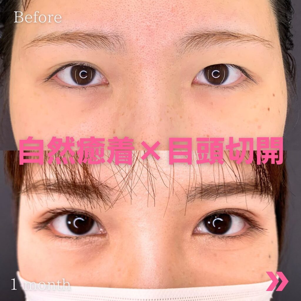 目頭切開と自然癒着法の症例写真