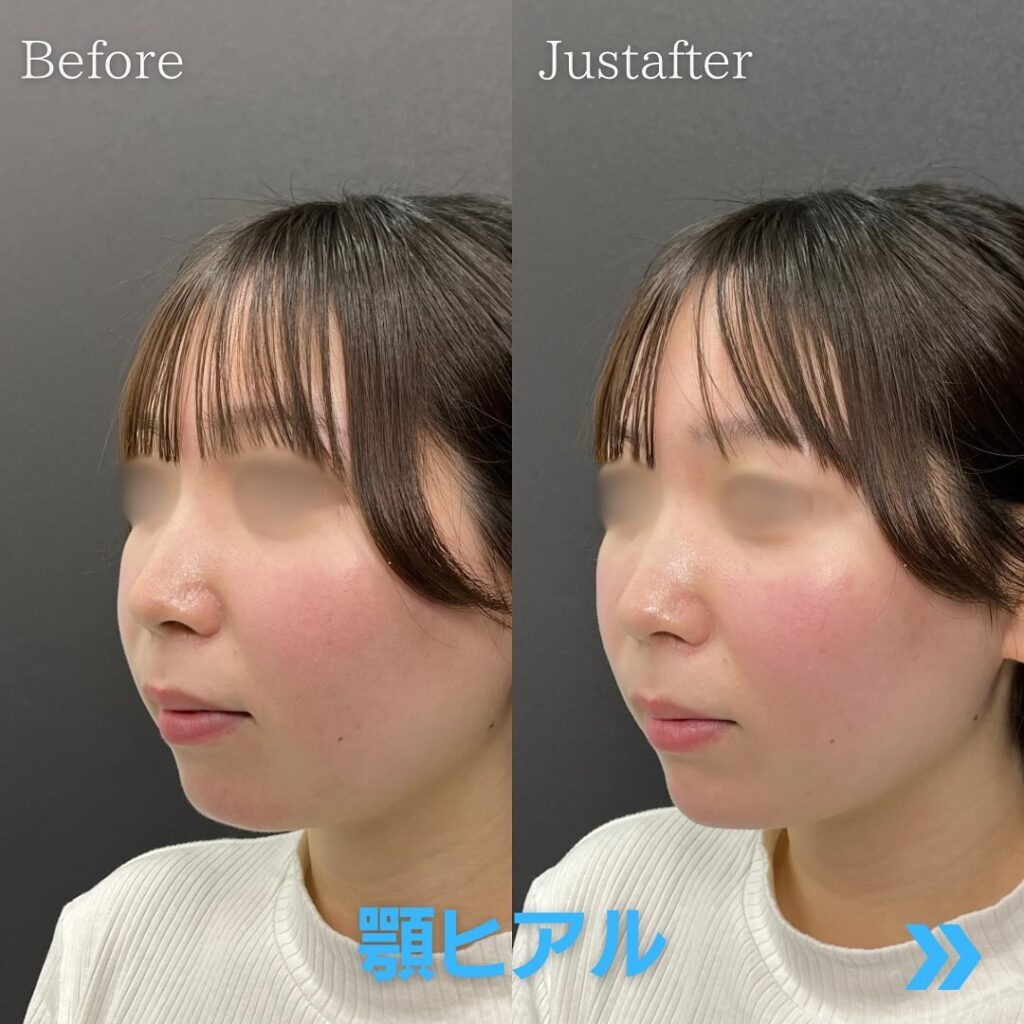 顎のヒアルロン酸の症例写真