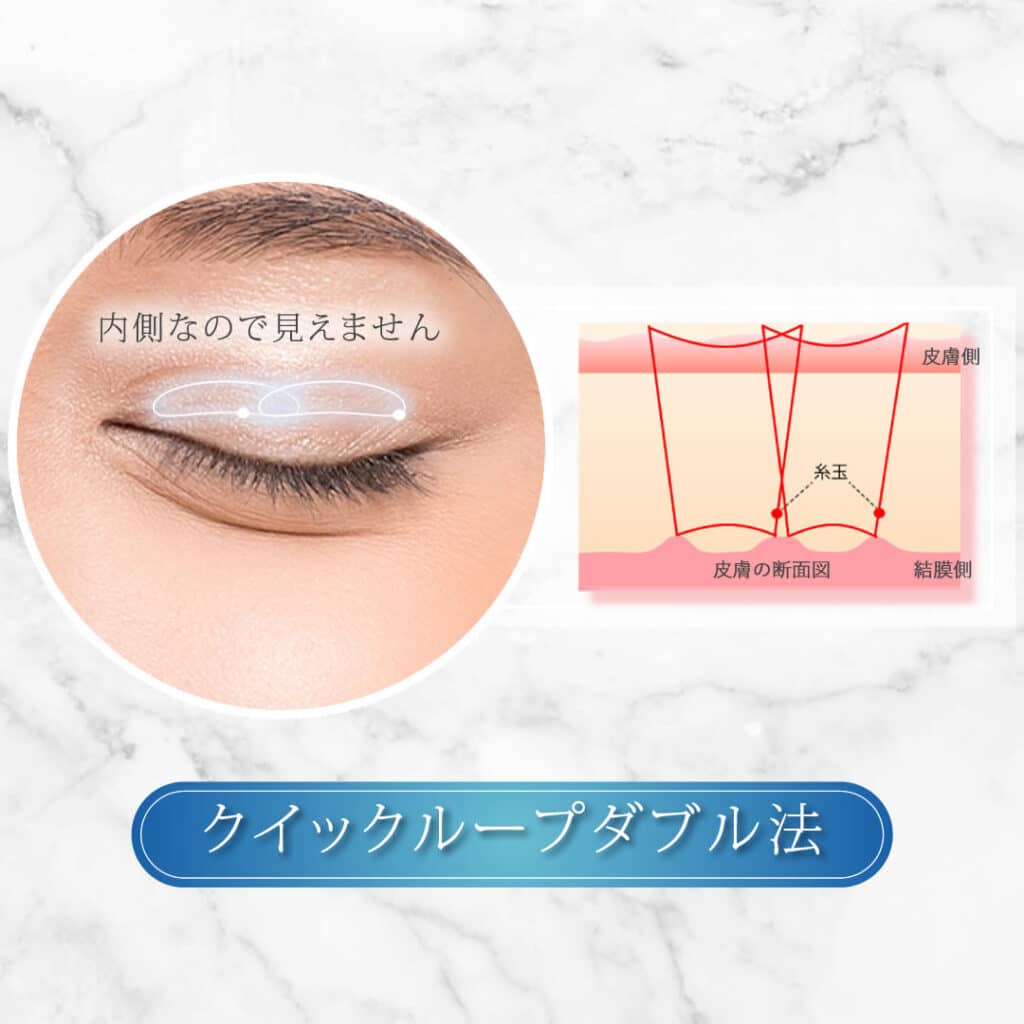 クイックループダブル