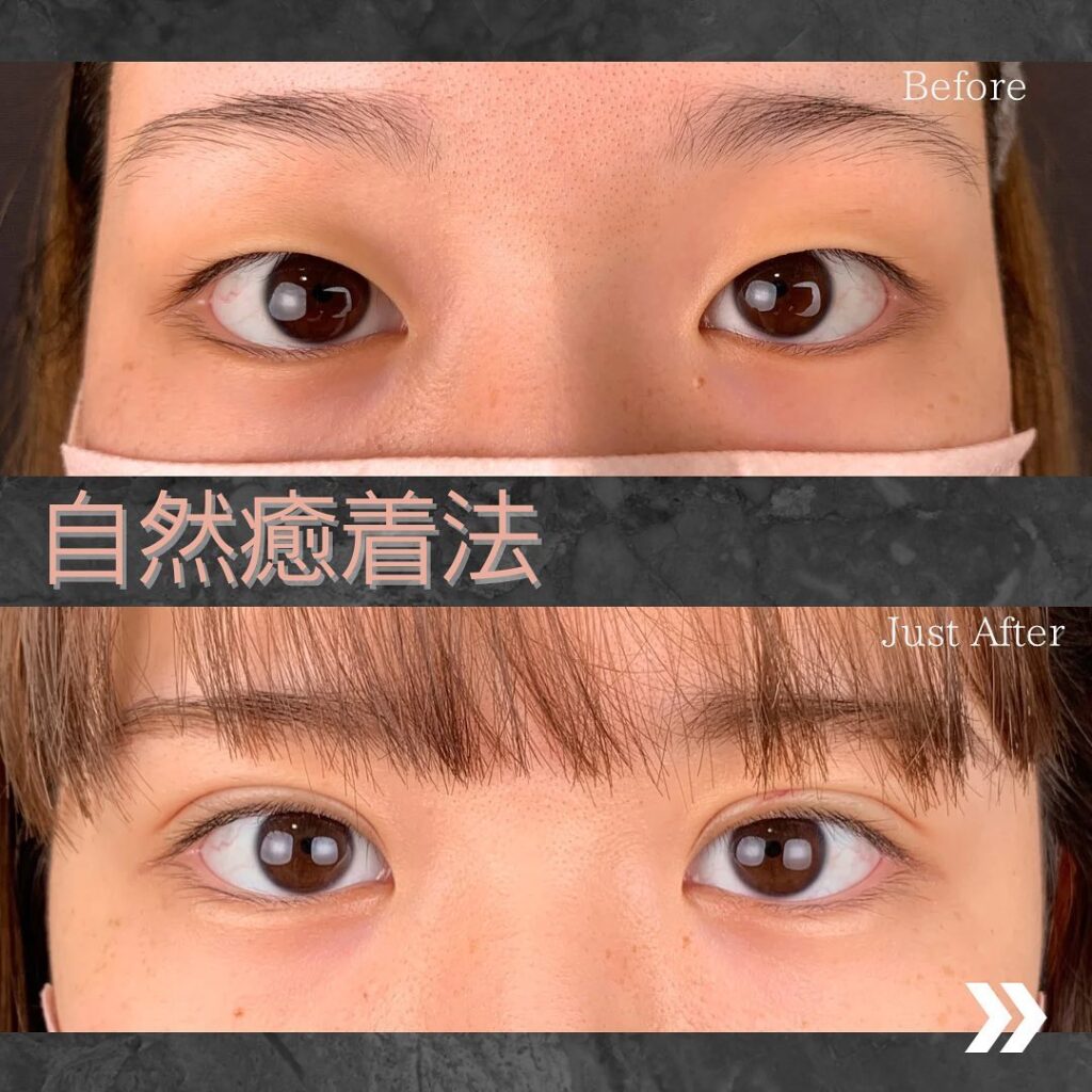 自然癒着法の埋没法の症例写真 (2)