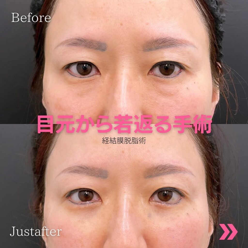 目元から若返らせた症例写真