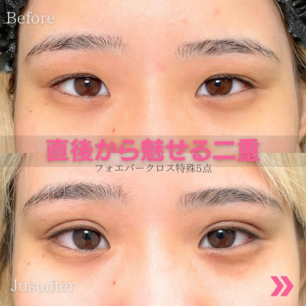 フォーエバークロスでした埋没法の症例写真