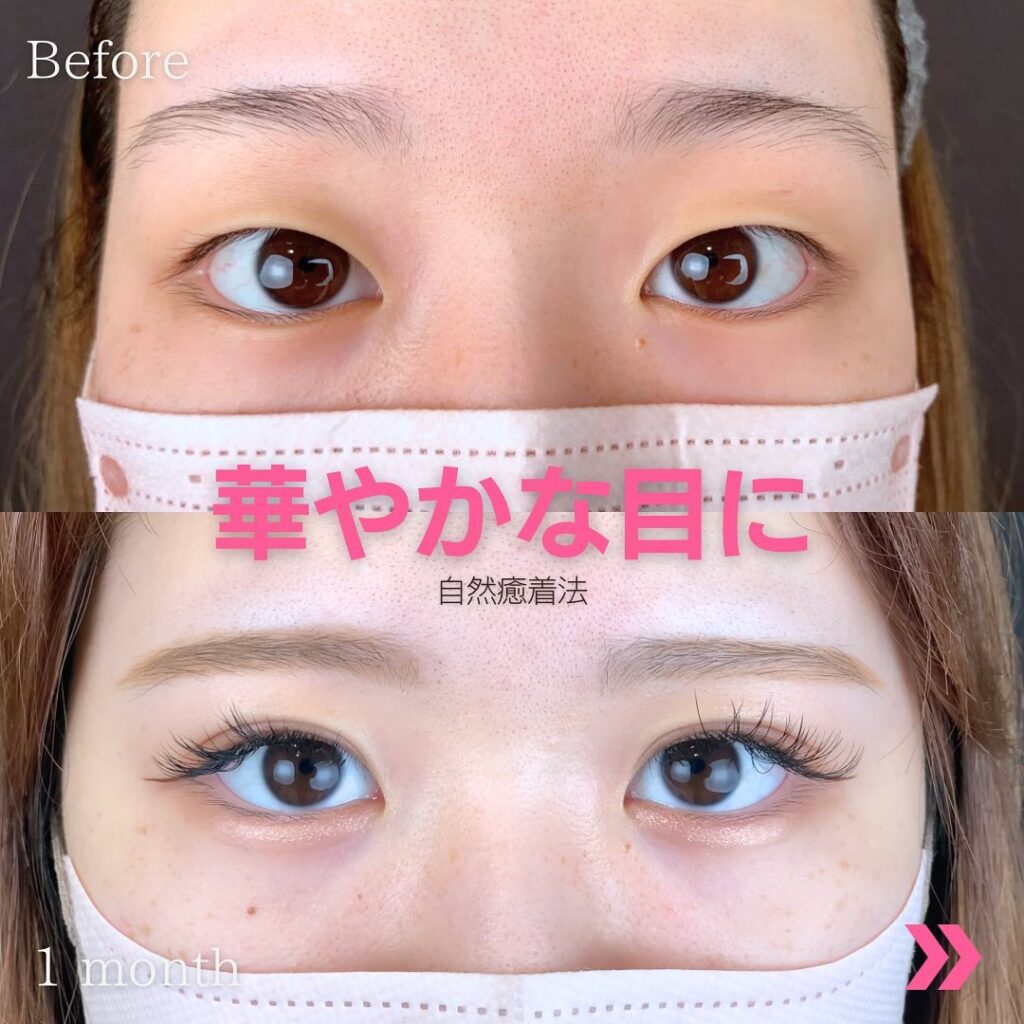 自然癒着法の埋没法の20代の症例写真