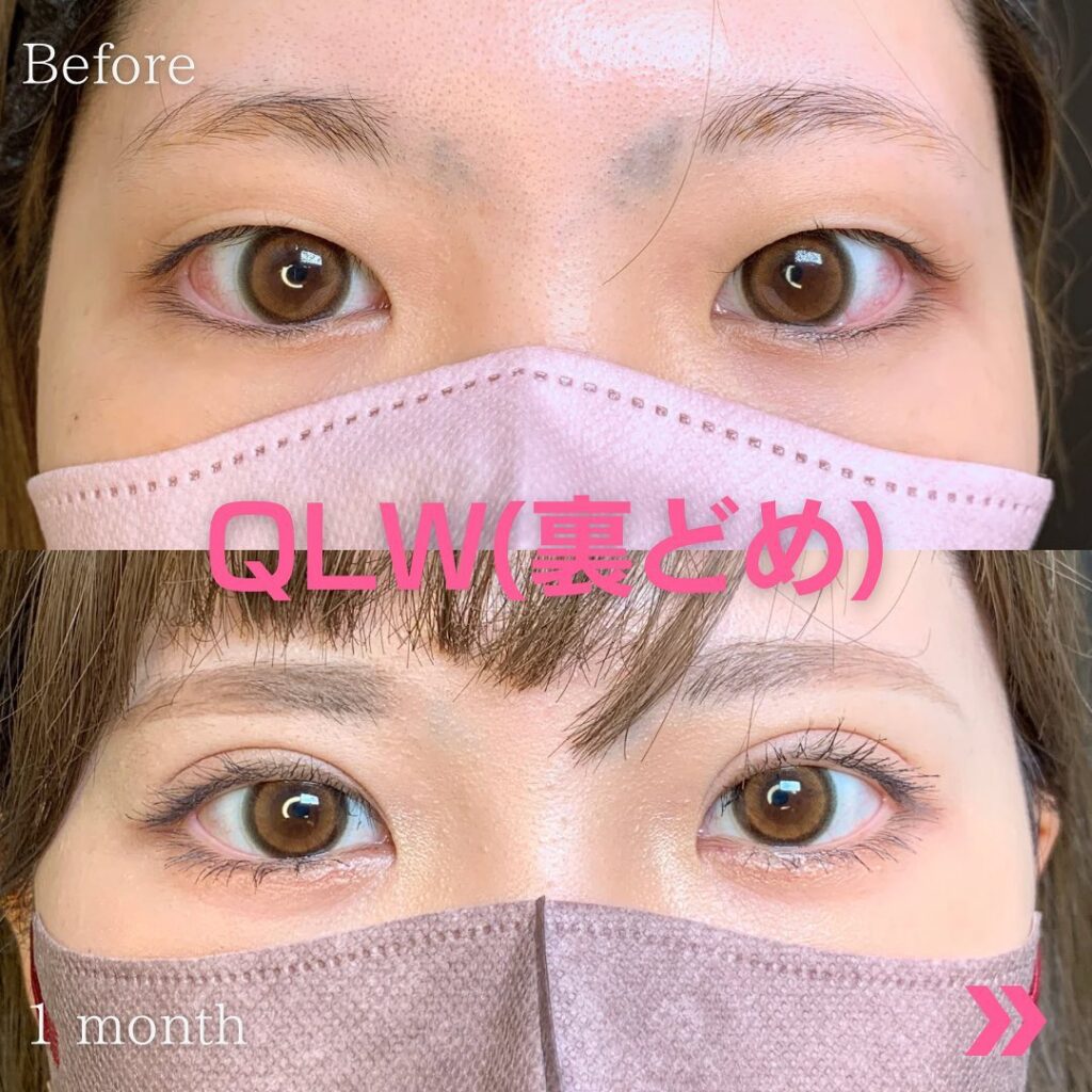 裏留めの症例写真