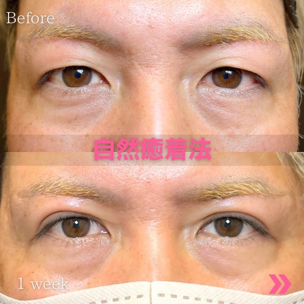 自然癒着法の埋没法の症例写真 (1)