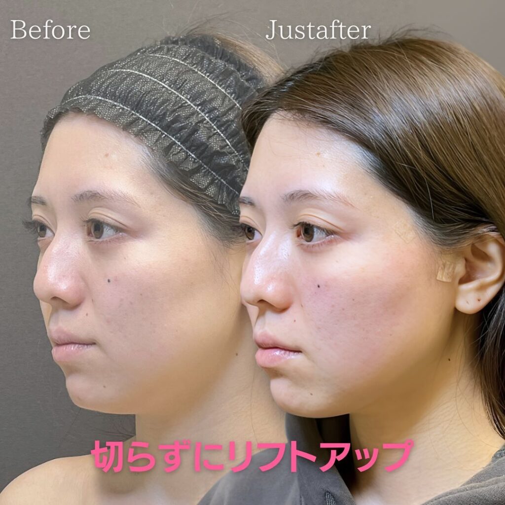 リフトアップした症例写真