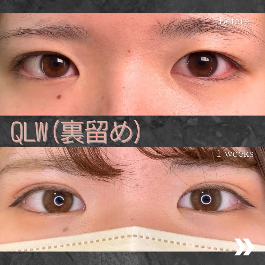 裏留めの埋没法の症例写真