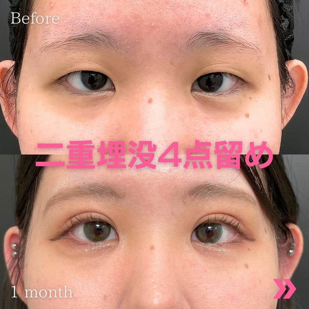 ４点留めの症例写真