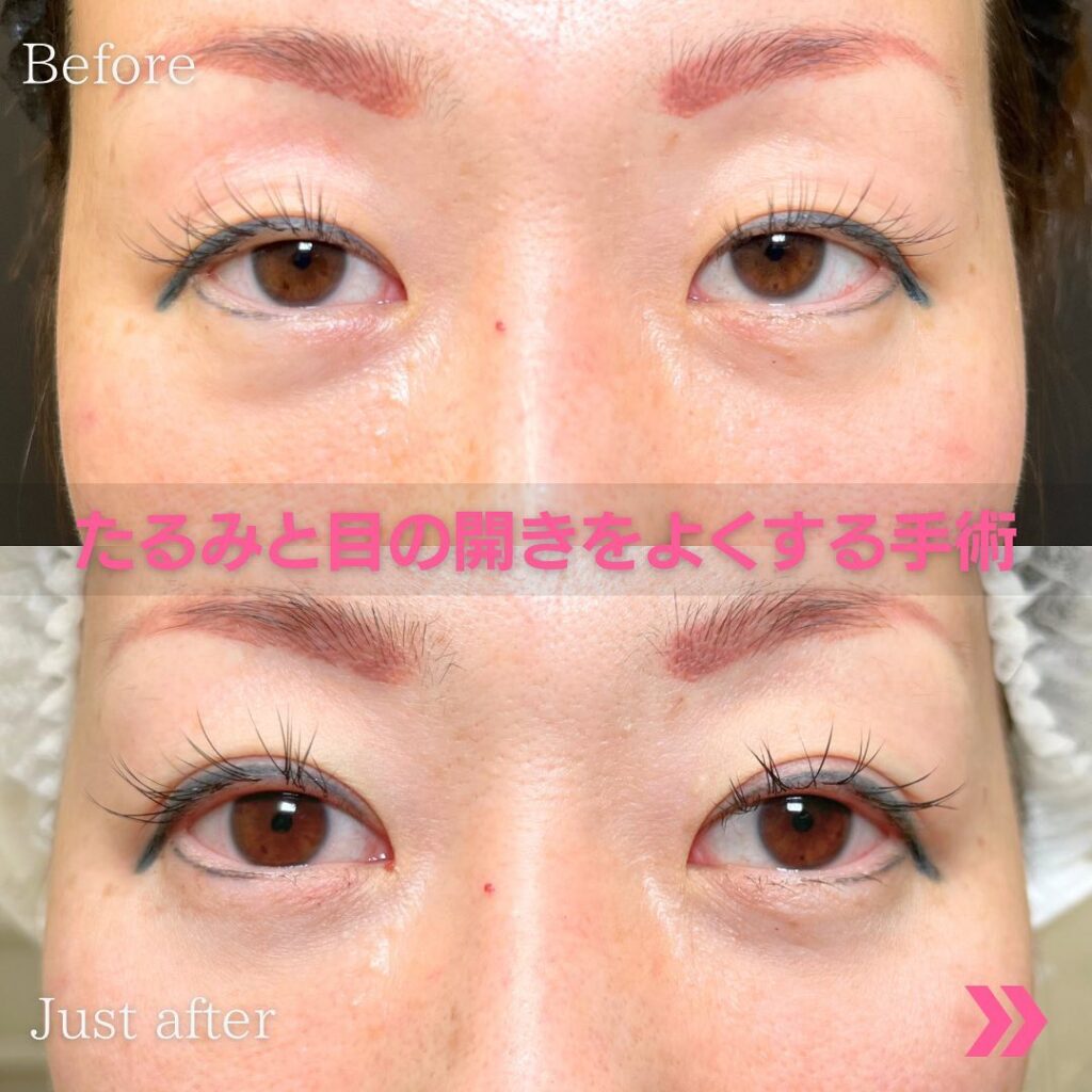 目のたるみを取った症例写真