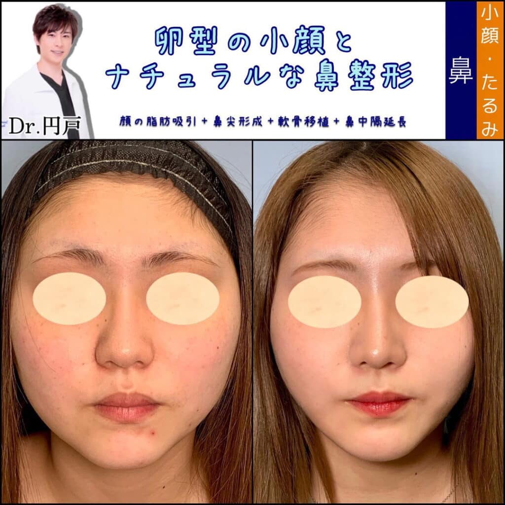 eclinic富山駅前院の顔の脂肪吸引と鼻尖形成と軟骨移植と鼻中隔延長の症例写真