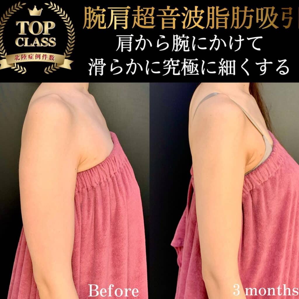 eclinic富山駅前院の腕脂肪吸引の症例写真