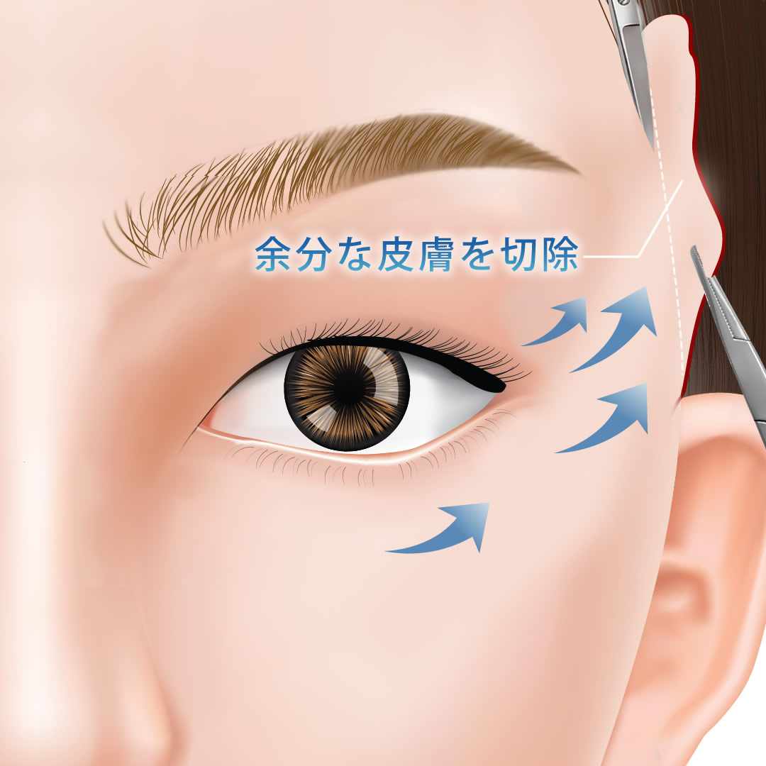 こめかみリフト