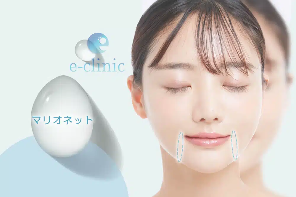 マリオネットライン