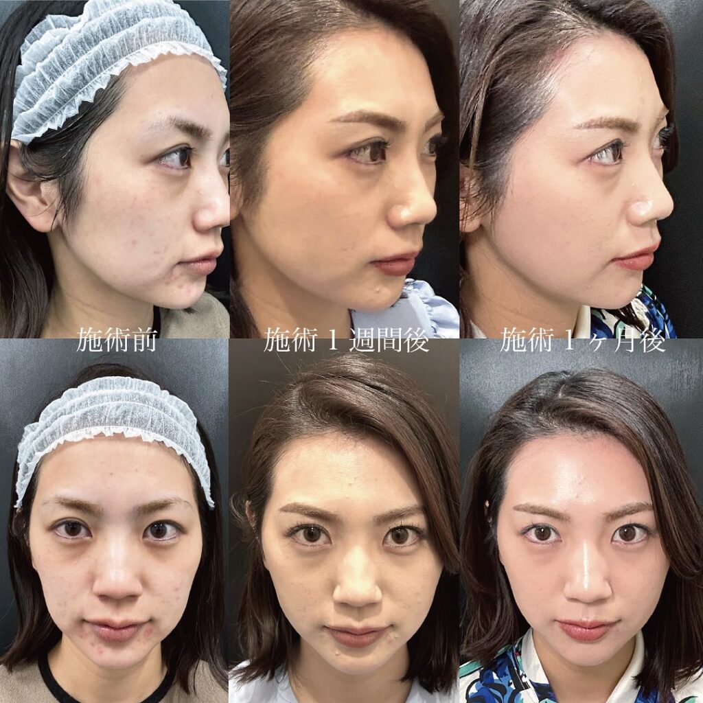 糸リフトの施術前と1週間後と1か月後の経過の症例写真