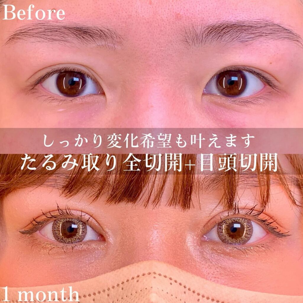 eclinic富山駅前院のたるみ取り併用全切開二重術＋目頭切開