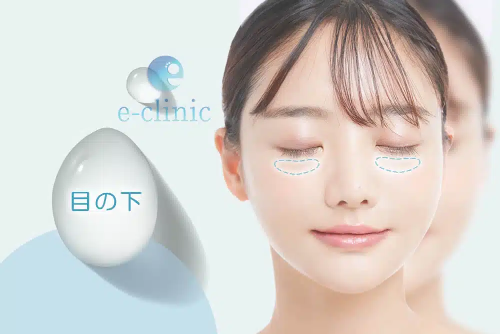 目の下ヒアルロン酸