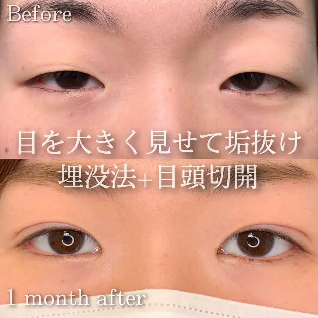 埋没法 目頭切開