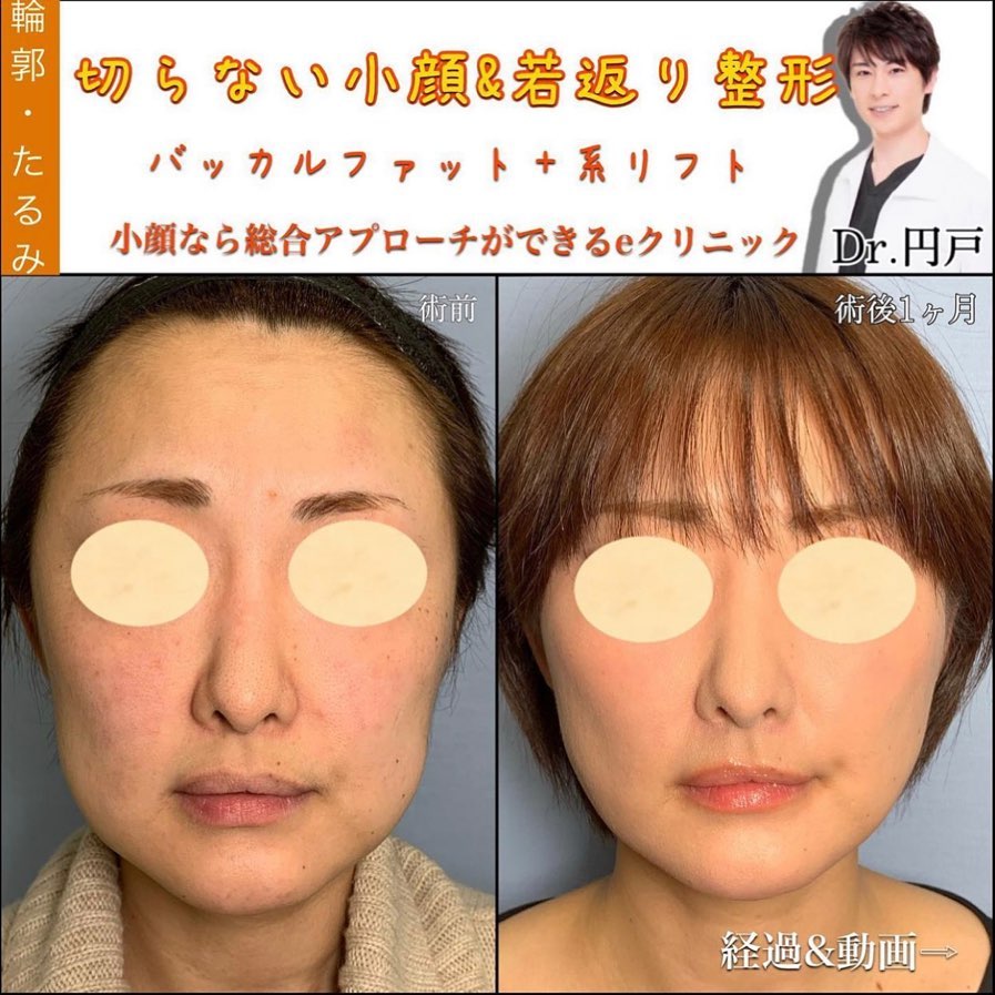 バッカルファット 糸リフト