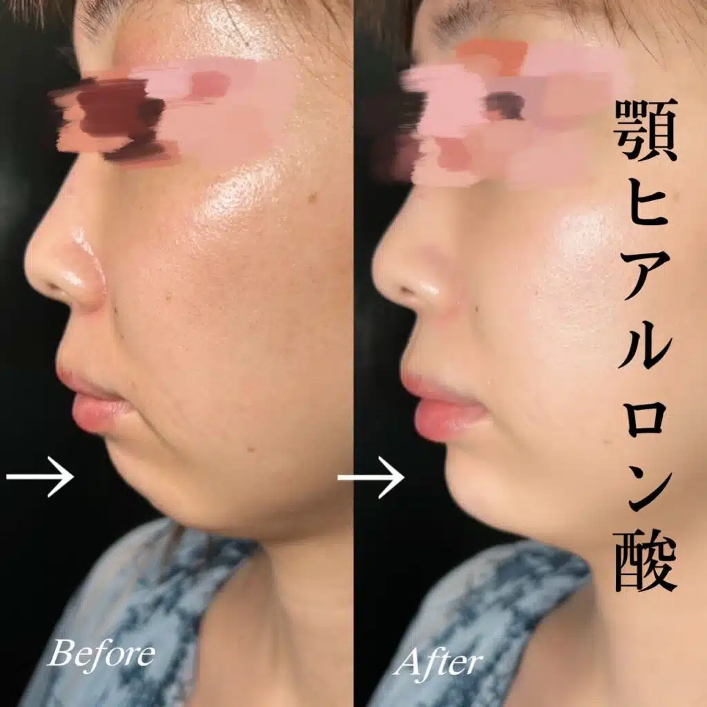 顎ヒアルロン酸