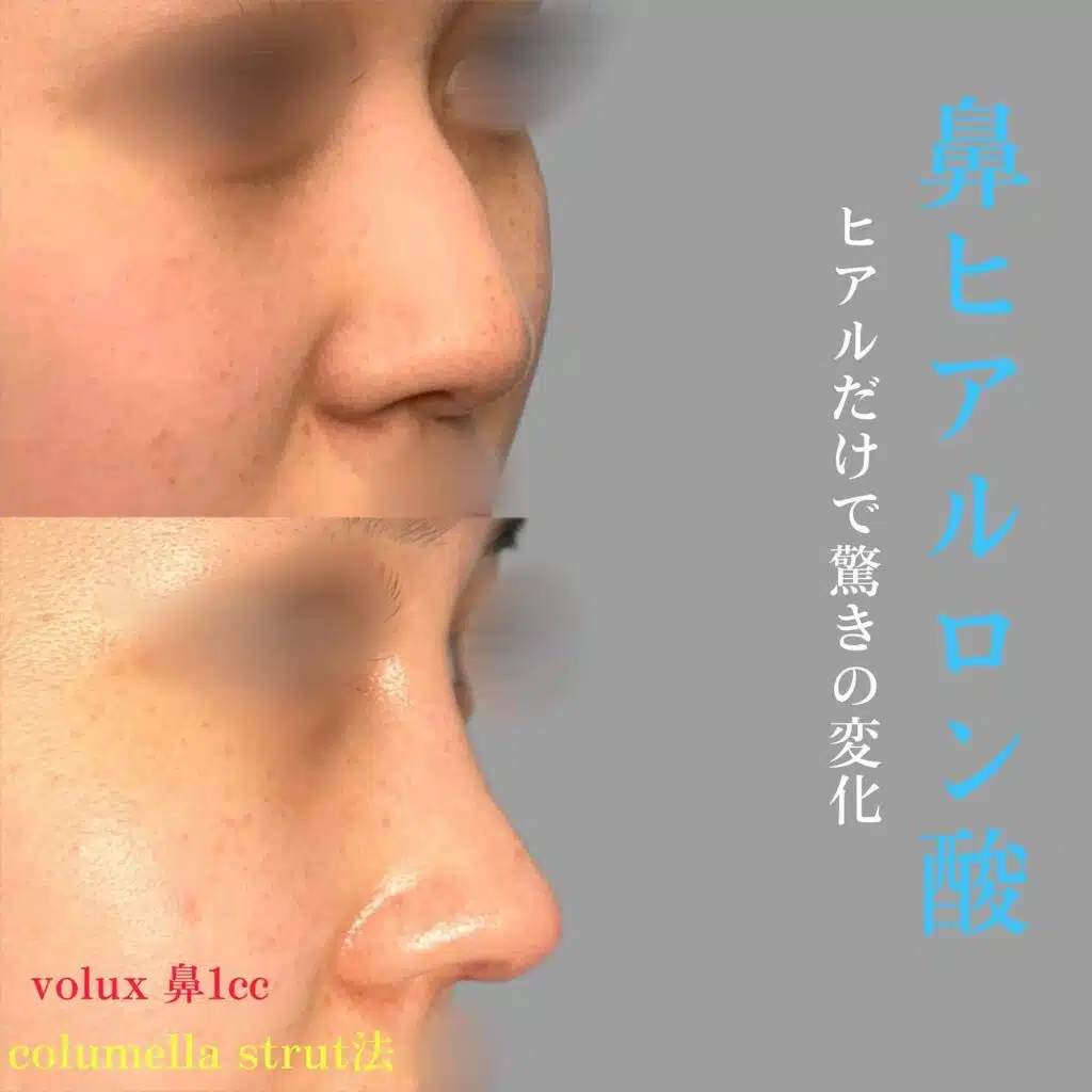 鼻ヒアルロン酸