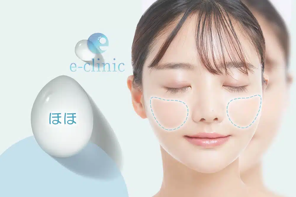 頬　ヒアルロン酸