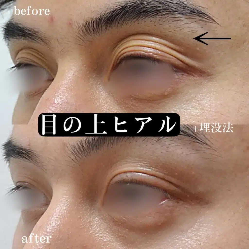 目の上ヒアルロン酸