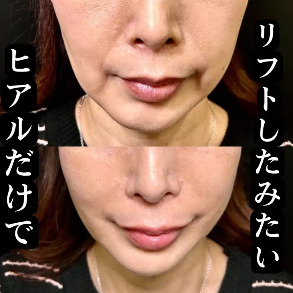 ヒアルロン酸リフト