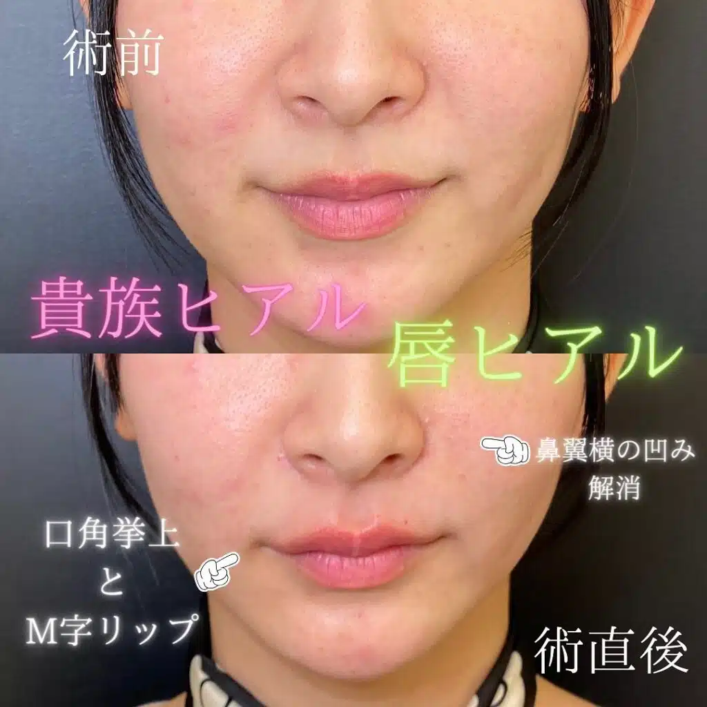 唇ヒアルロン酸