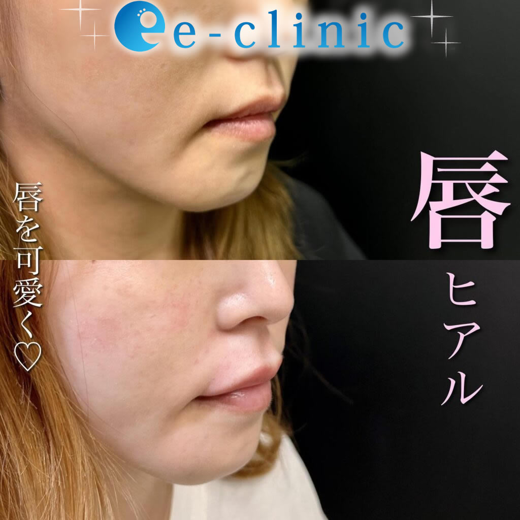 唇ヒアルロン酸