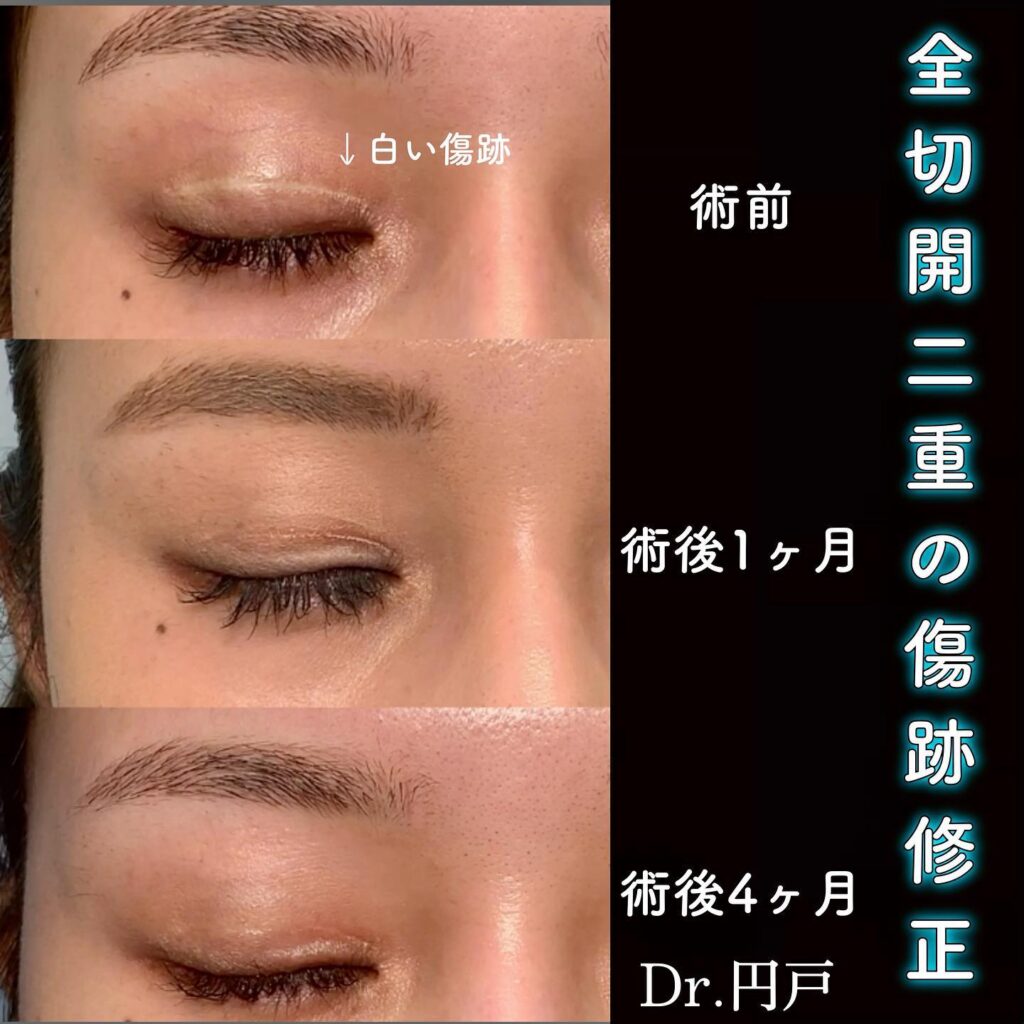 eclinic富山駅前院の全切開二重術の他院傷跡修正