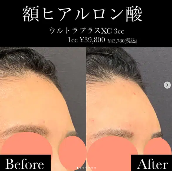 額ヒアルロン酸