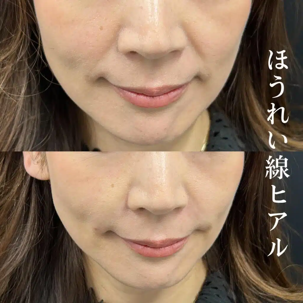 ほうれい線ヒアルロン酸