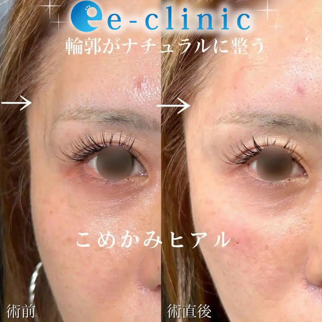 こめかみヒアルロン酸