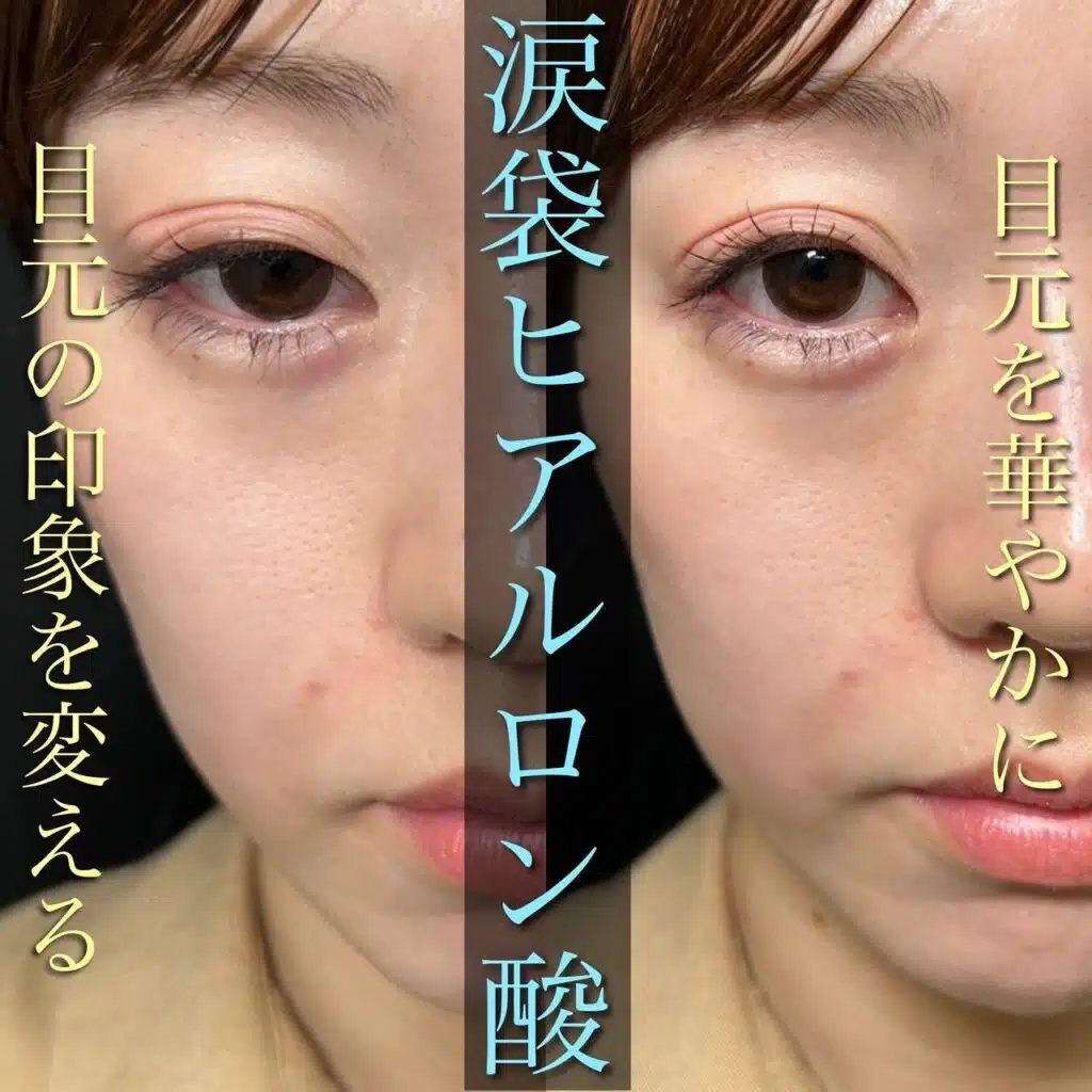 涙袋ヒアルロン酸