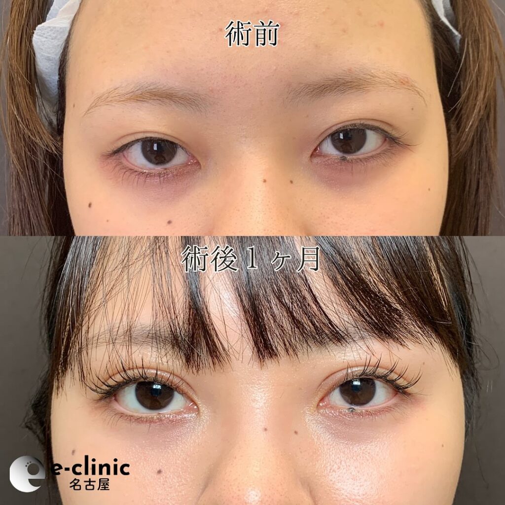 eclinic富山駅前院の全切開二重術