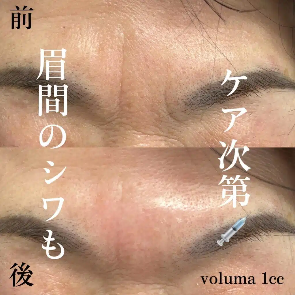 眉間ヒアルロン酸