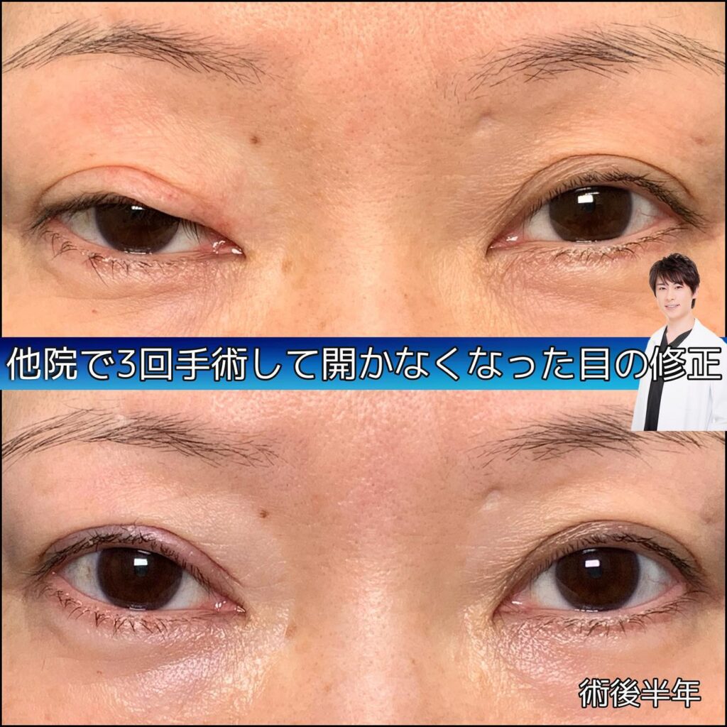 eclinic富山駅前院の全切開二重術他院修正