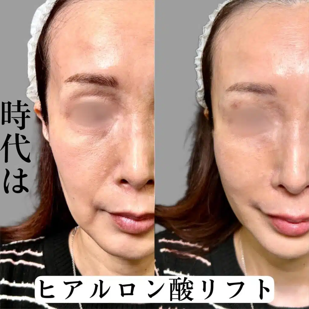 ヒアルロン酸リフト