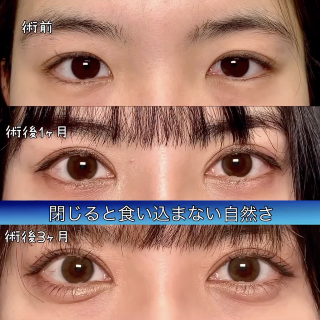 eclinic富山駅前院の全切開二重術