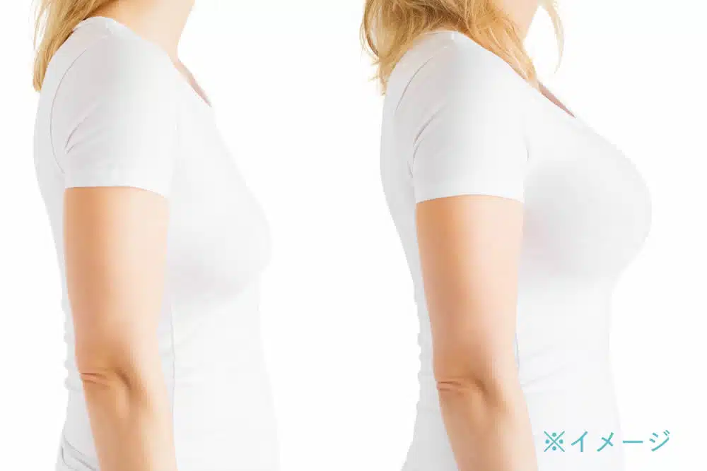 ヒアルロン酸豊胸