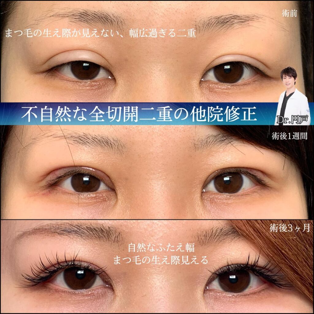 eclinic富山駅前院の全切開二重術の他院修正