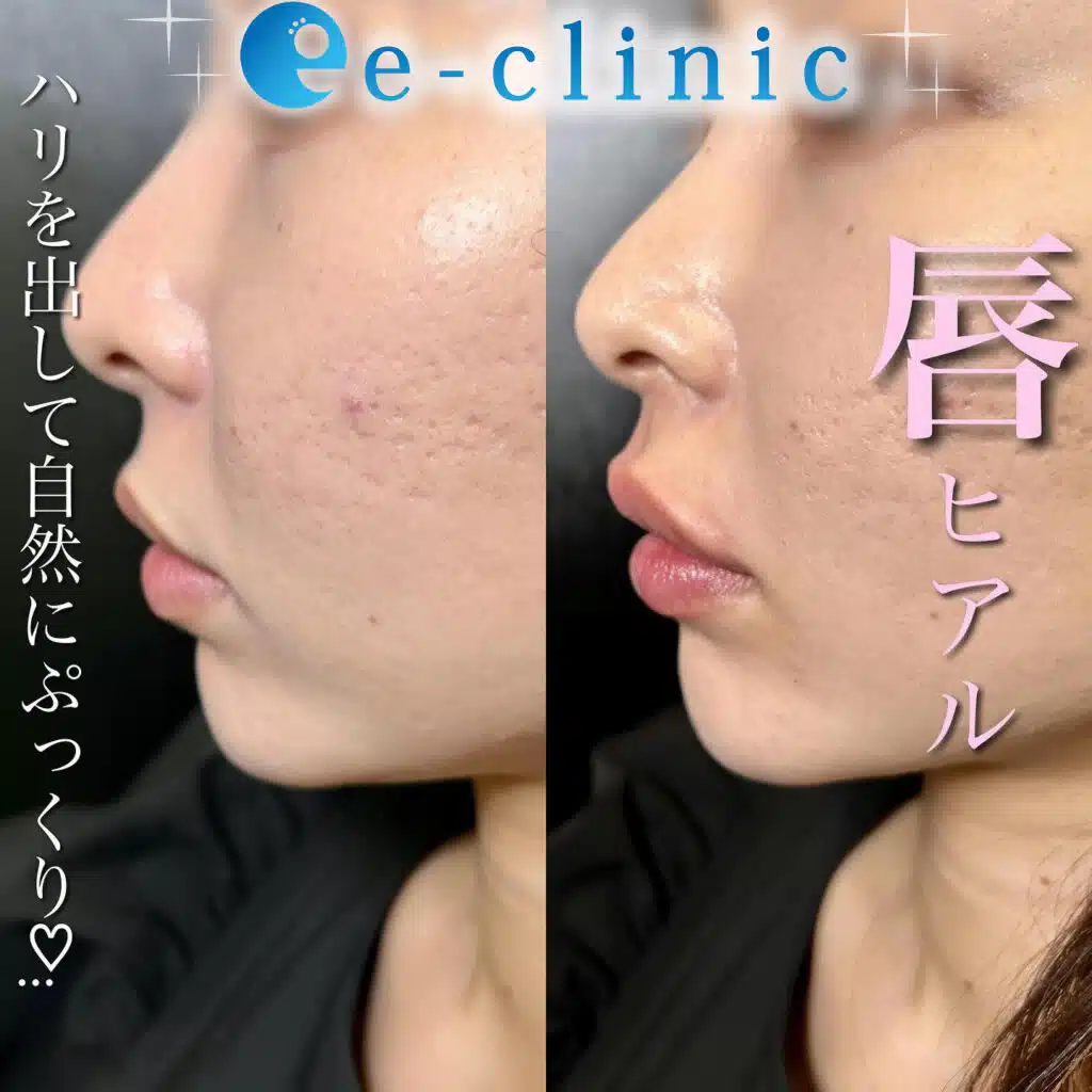 唇ヒアルロン酸