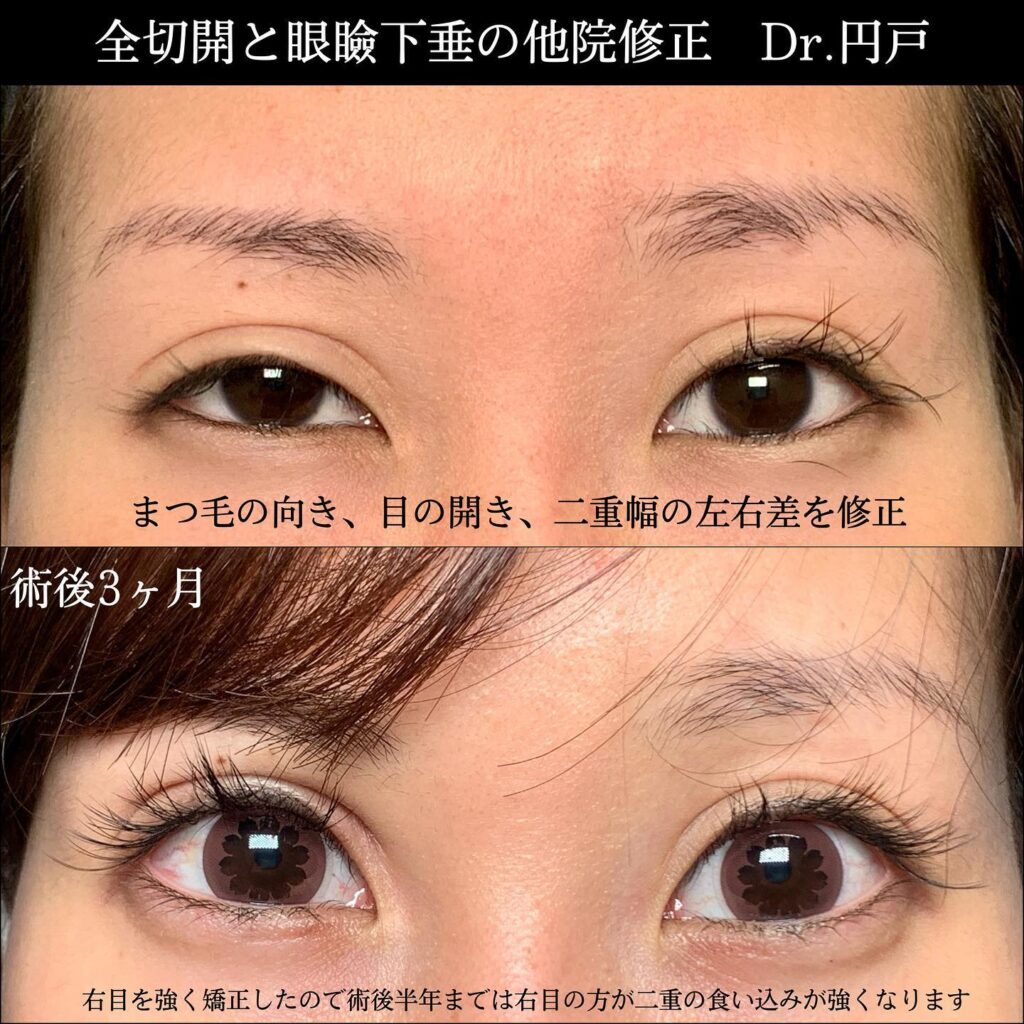 eclinic富山駅前院の全切開二重術の他院修正＋眼瞼下垂