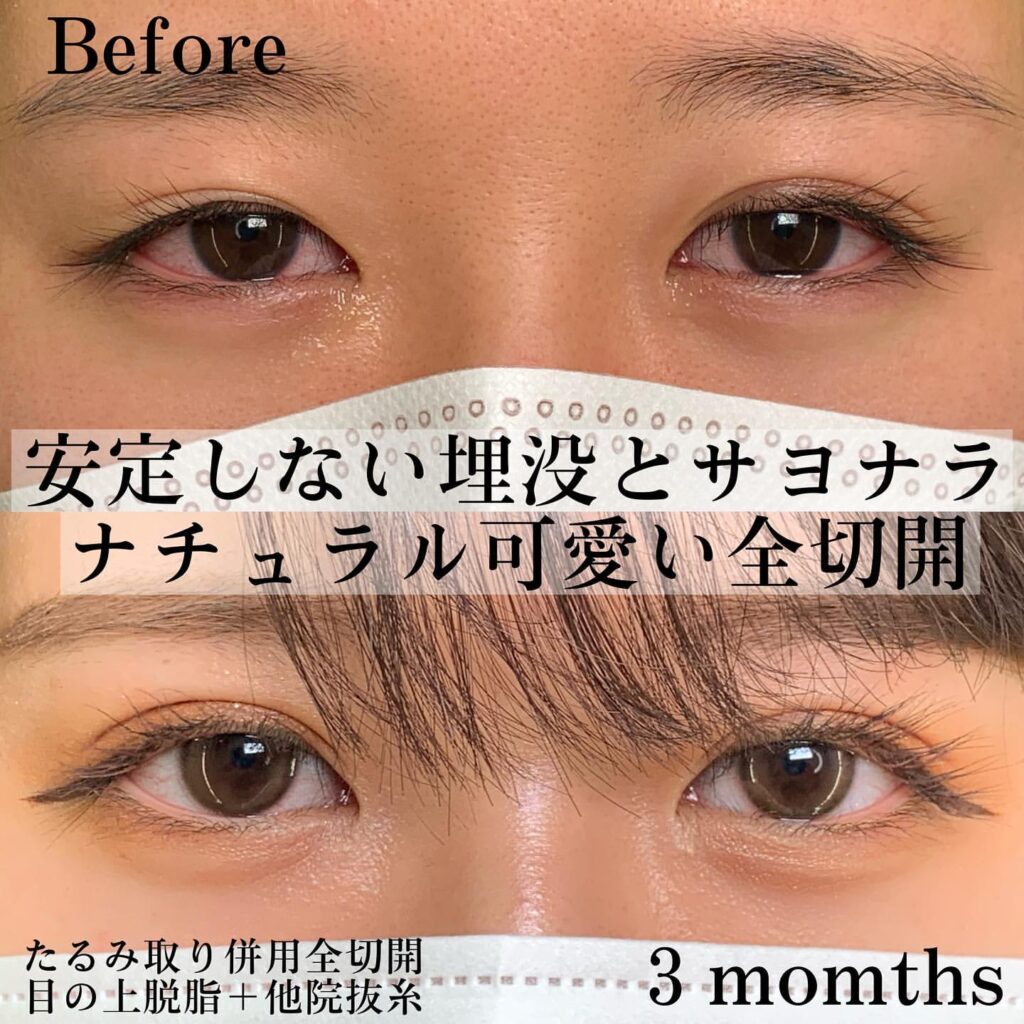 eclinic富山駅前院のたるみ取り併用全切開二重術＋目の上脱脂＋他院抜糸